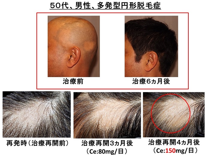 円形脱毛症　病院